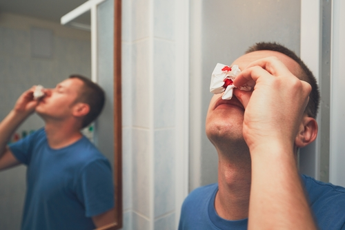 man with nosebleed tilting head back with bloody tissue