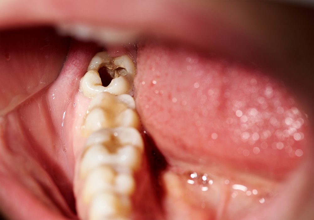 tooth decay in mouth